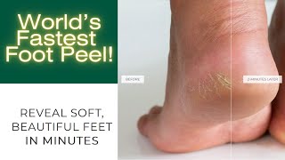 Worlds Fastest Foot Peel 100 Natural Instant Foot Peeling Spray Removes Feet Callus Fast at Home [upl. by Merilyn]