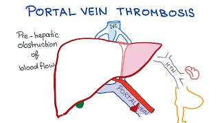 Portal Vein Thrombosis [upl. by Nidnerb]