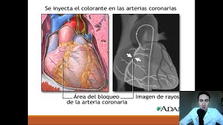 Cateterismo Cardiaco Stents y Cirugía de Bypass [upl. by Burkle]