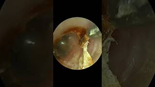 PLUCKING the Deepest Earwax With Skin Peeling [upl. by Theone812]