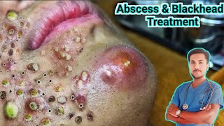 Abscess Treatment Causes Symptoms and Removalquot [upl. by Antoinetta]