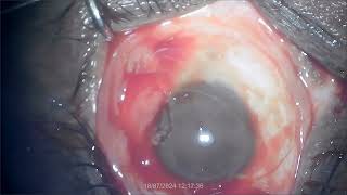 Pterygium excision with autograft By Dr K L Agrawal [upl. by Ainirtac]