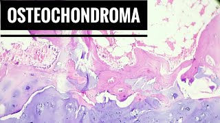 Osteochondroma Histopathology [upl. by Thekla]