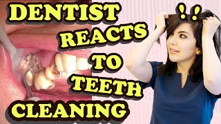 Dentist Reacts to Teeth Cleaning Videos [upl. by Euqinom747]