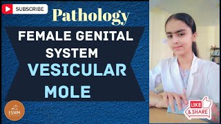 Vesicular Mole in Pathology EXPLAINED [upl. by Lanrev127]