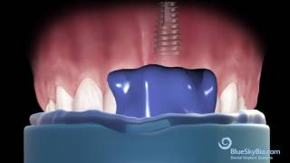 Custom Abutment from Multi Purpose Abutment [upl. by Adnicul661]