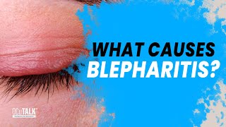 What causes blepharitis Dr Hosein explains [upl. by Reinal]