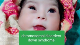 chromosomal disorders down syndrome in new born baby cute cutebaby newbornbaby medical viral [upl. by Bekelja752]