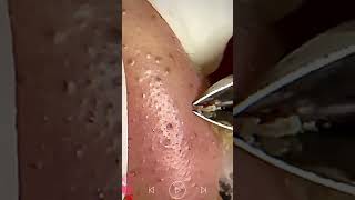 Skincare  Blackheads Removal 157 skincare skincare blackheads blackheads [upl. by Anuait]