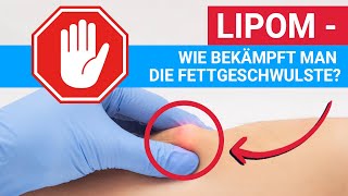 Lipom  wie bekämpft man die Fettgeschwulste [upl. by Agemo]