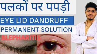 पलकों पर पपड़ी आना Permanent इलाज। Blepharitis treatment [upl. by Ddal]