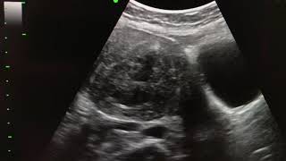 Submucosal fibroid USG Ultrasound [upl. by Anisamot590]