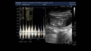 Anencephaly with a pregnancy of about 16 weeks [upl. by Mitch65]