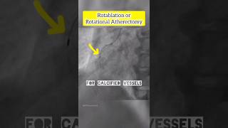 Rotablation rotational Atherectomy angiogram angioplasty cardiology heart shorts [upl. by Jacklin]