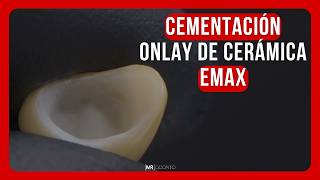 CEMENTACIÓN DE ONLAY CERÁMICO EMAX [upl. by Cassy]