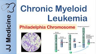 Chronic Myeloid Leukemia CML  Pathogenesis Symptoms and Treatment [upl. by Hilliary227]