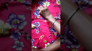 Hirayama disease patientsurgery karne ka bad hand condition [upl. by Nywnorb]