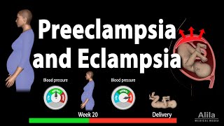 Preeclampsia and Eclampsia Animation [upl. by Mungo]