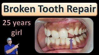 Broken Tooth Repair in 25 year old girl [upl. by Ancell219]