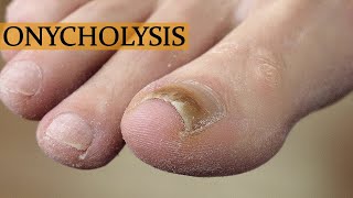 DEEP CLEANING OF THE TOENAIL WITH ONYCHOLYSIS [upl. by Rayle]