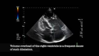 Severe pulmonic regurgitation [upl. by Manas]