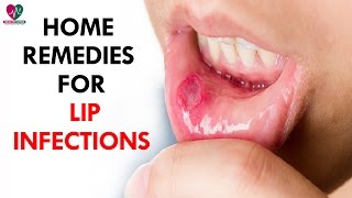 Home Remedies For Of Lip Infections  Health Sutra [upl. by Ennagem850]