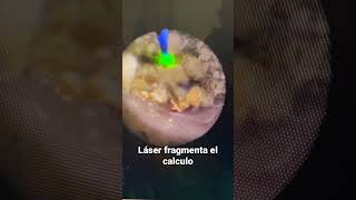 LASER para piedras del riñón  urotips [upl. by Bonne]