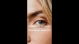 Brow Lift Surgery  Endoscopic vs Traditional Brow Lift with Dr Guy Massry [upl. by Enelyt]