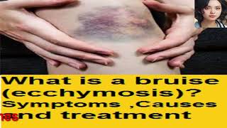 What is a bruise ecchymosis Symptoms  Causes and treatment [upl. by Melleta]