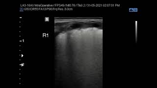 4RDS neonatal respiratory distress syndrome [upl. by Anaujat]