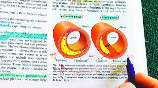 Atherosclerosis Robbins Pathology Atherosclerosis vs Arteriosclerosis  Atherosclerosis Pathology [upl. by Acimad]