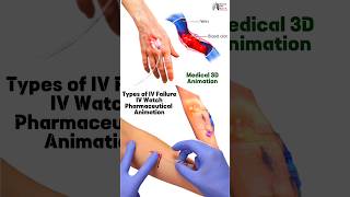 Types of IV Failure IV Watch Pharmaceutical Animation medical animation3d short BiologywithAliya [upl. by Aleafar]