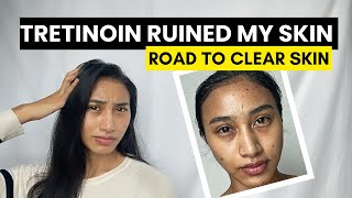 TRETINOIN JOURNEY SKIN PURGING [upl. by Ahsienahs]