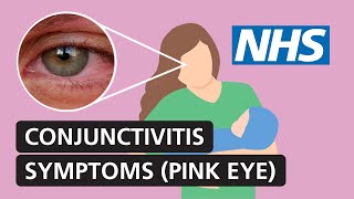 Conjunctivitis symptoms and treatment for red itchy watery eyes  NHS [upl. by Sunderland]