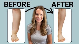 The Best Leg Lymphedema Treatment [upl. by Anatniuq491]