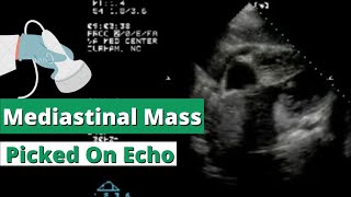 Echocardiography showing Mediastinal Mass in Subcostal View [upl. by Hoeg]