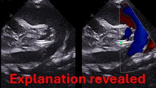 Truncus arteriosus  single ventricle and more  Explanation of case 1 [upl. by Dorman]