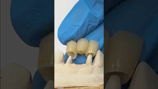 Zen Enamel Pontic Bridge lsk121shorts dentistteeth [upl. by Lledner208]