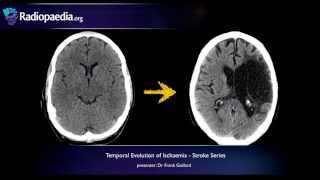 Stroke Evolution from acute to chronic infarction  radiology video tutorial CT MRI [upl. by Anawat]