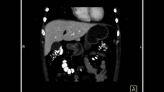 Abdomen Liver Focal Nodular Hyperplasia CT Angiography6 of 6 [upl. by Akemed]