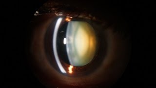 Slit Lamp examination of the anterior segment of the eye [upl. by Sibelle]