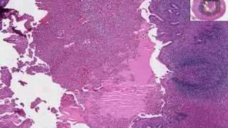 Histopathology Acute Appendicitis [upl. by Latoniah]