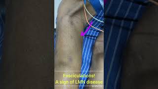 Fasciculations  A Sign of LMN diseaseDrKamaleshTNMediCalLectures mnd als anteriorhorncell [upl. by Ayihsa798]