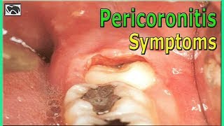 What is Pericoronitis Causes and Symptoms  Wisdom Teeth [upl. by Suellen371]