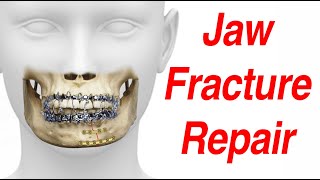 Jaw Fracture Surgical Treatment Animation MMF  ORIF [upl. by Frederigo]