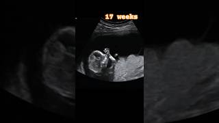 Ultrasound Scan Of 17 Week Old Fetus shorts babygirl ultrasound [upl. by Eceeryt]