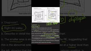 Hess Chart  Superior Oblique Palsy [upl. by Iris]