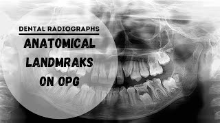 Dental panoramic radiographs  OPG  DPT Anatomical Landmarks [upl. by Ellen]