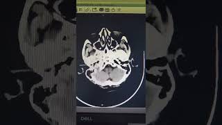 GBM Glioma Glioblastomamultiforme sagitalsinus [upl. by Suoicul]