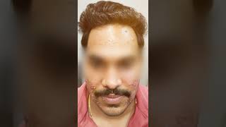 Severe Acne Treatment  3Month Transformation by Dr Amit Kerure  Navi Mumba [upl. by Ueihttam]